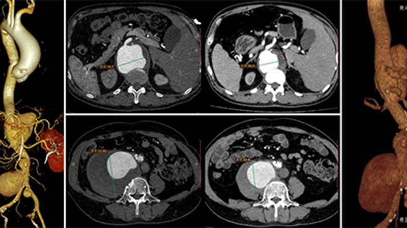 避免开胸开腹 省医血管外科改制开窗-分支支架技术治疗累及内脏动脉分支的复杂胸腹主动脉疾病